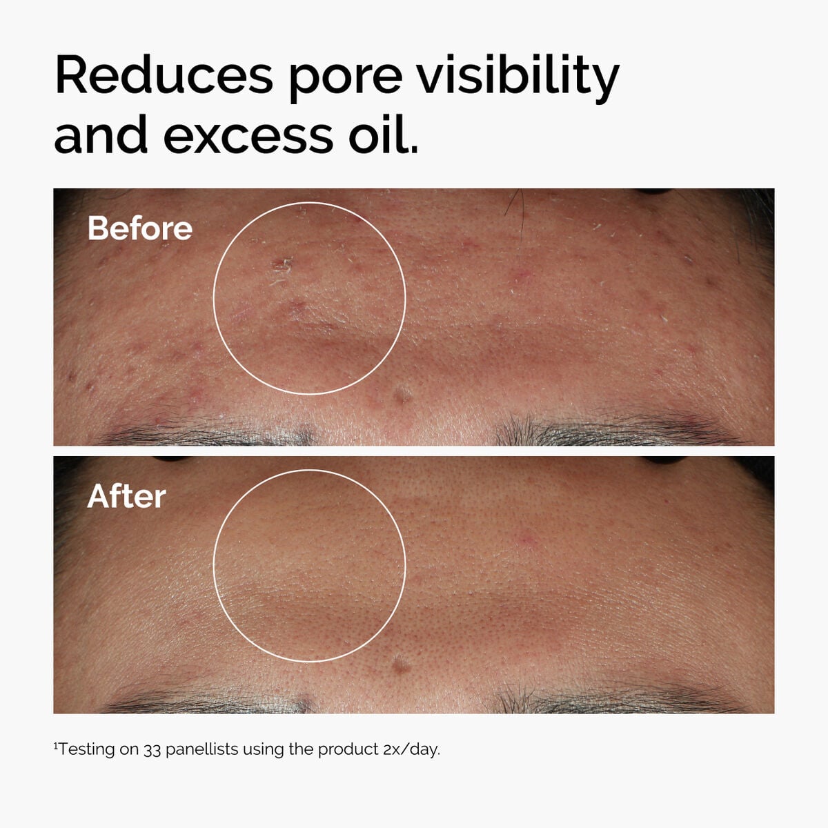 niacinamide-10-zinc-1-n5 ord-niacinamide-zinc-blemish-serum-before-after-pores.jpg
