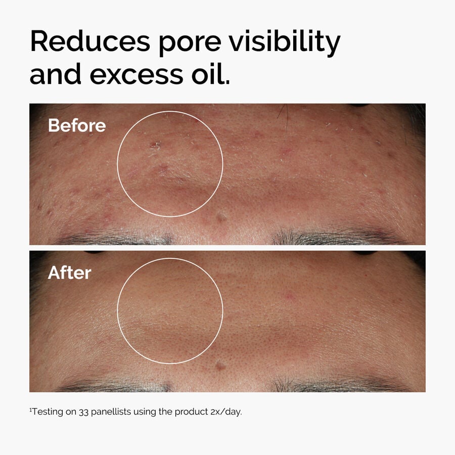 niacinamide-10-zinc-1-n5 ord-niacinamide-zinc-blemish-serum-before-after-pores.jpg