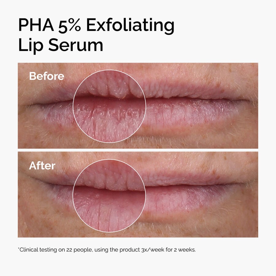 pha-5-exfoliating-lip-serum-d6 ord-pha-5pct-lip-exfoliating-serum-before-after.jpg