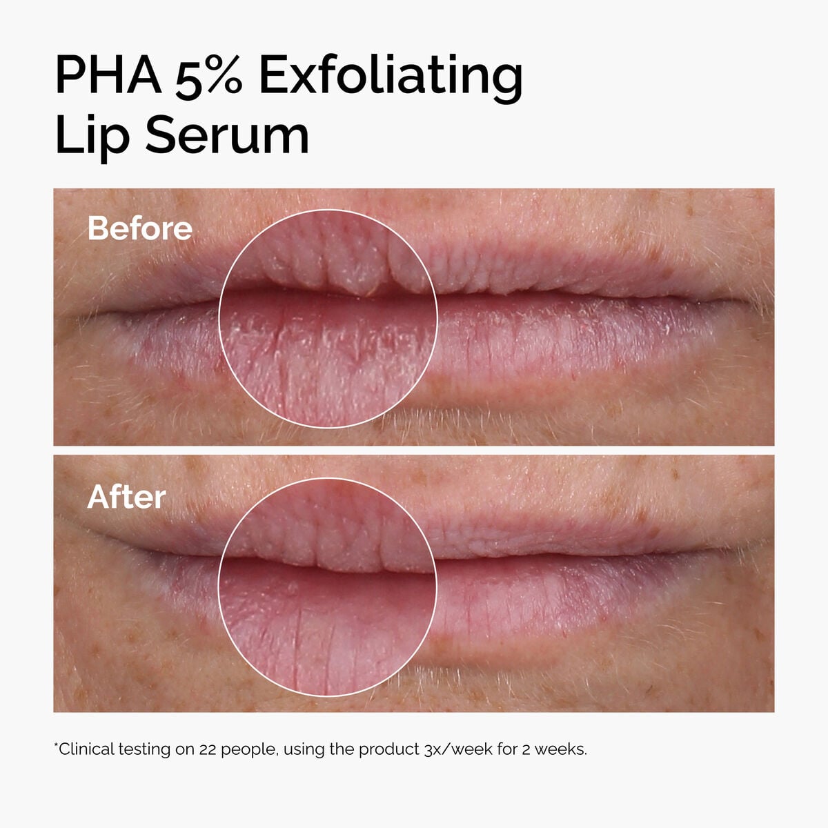 pha-5-exfoliating-lip-serum-d6 ord-pha-5pct-lip-exfoliating-serum-before-after.jpg